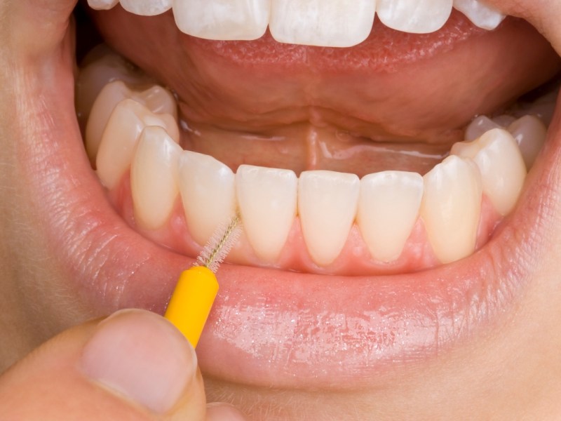 Zahnstein: wie du ihn ohne Zahnarzt selbst entfernen kannst