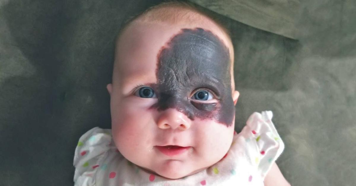 Baby wird mit großem Muttermal im Gesicht geboren. Heftig
