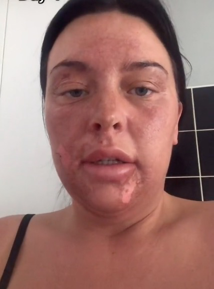 Eine Frau mit Verbrennungen im Gesicht