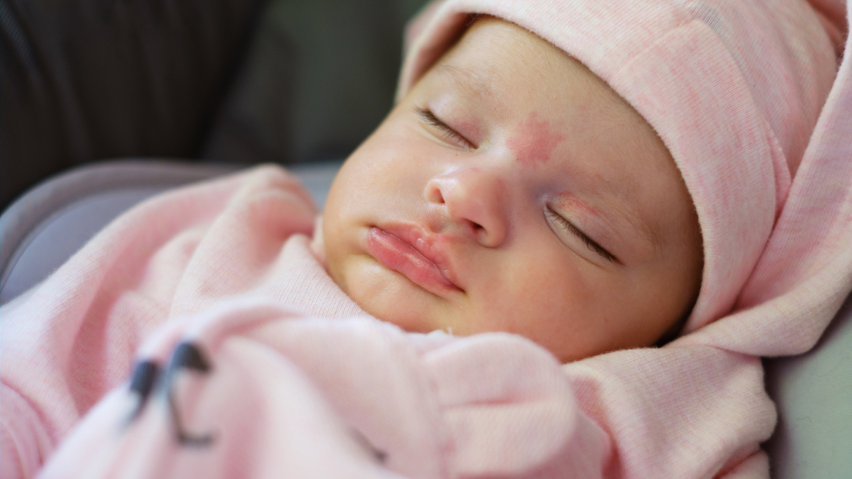 Ein schlafendes 2 Monate altes Mädchen mit einem Muttermal auf der Stirn.