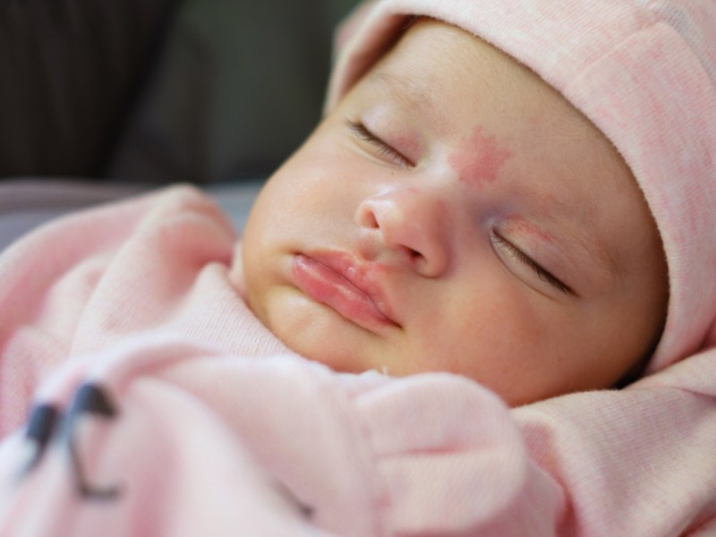 Ein schlafendes 2 Monate altes Mädchen mit einem Muttermal auf der Stirn.