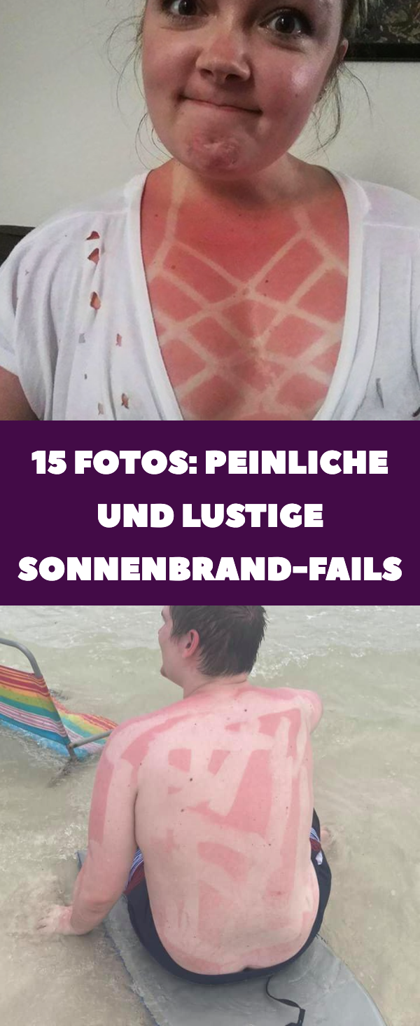 15 Bilder: peinliche und lustige Sonnenbrand-Fails