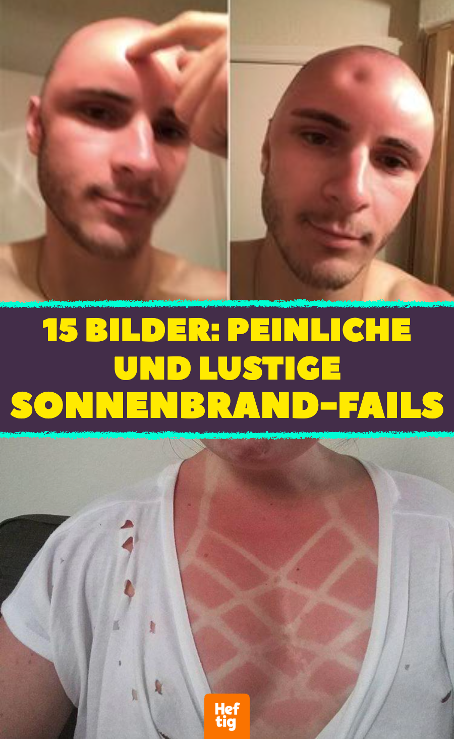 15 Bilder: peinliche und lustige Sonnenbrand-Fails