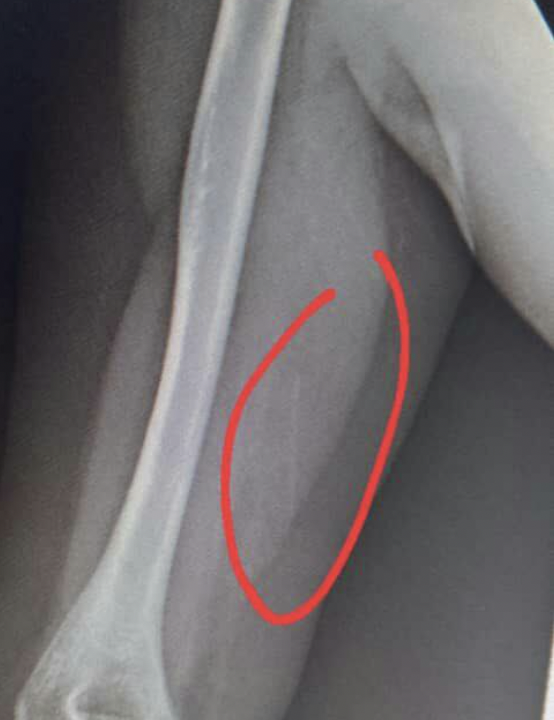 Ultraschallbild von Arm zeigt Lolli-Implantat