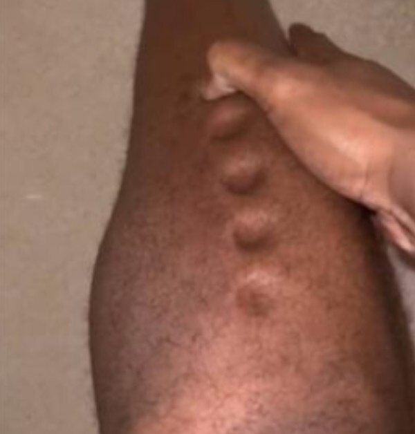 Lawrence Okoye hat in seinem TikTok-Video eine Reihe von 5 Dellen in sein Bein gedrückt.