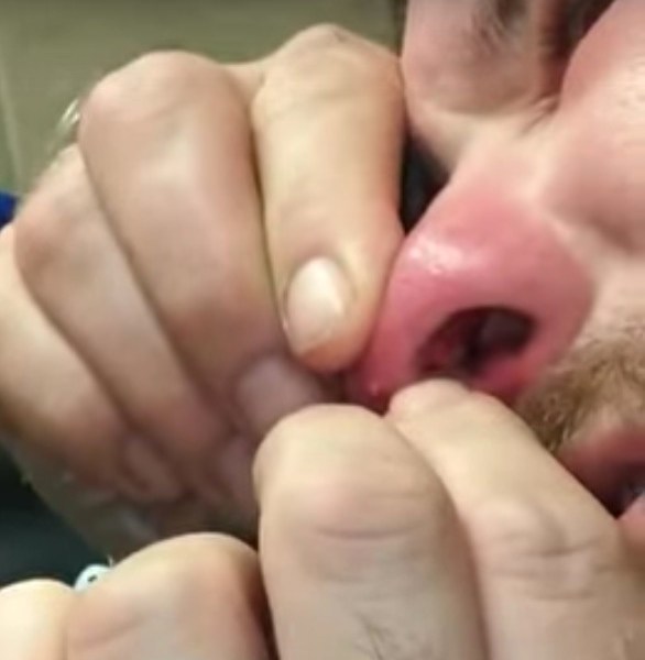 Mann drückt Pickel in der Nase aus