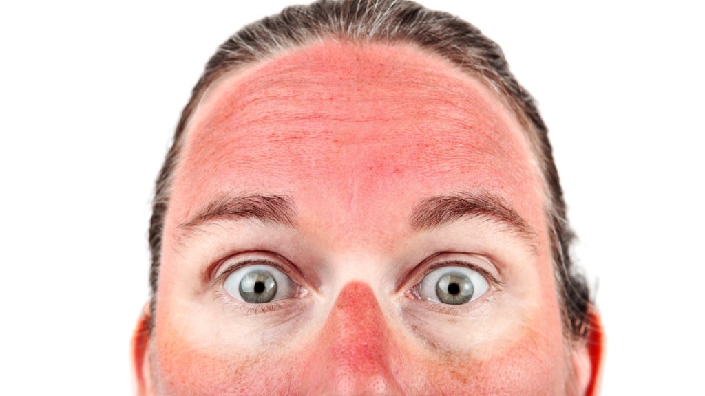Eine Frau mit Sonnenbrand im Gesicht und Brillenabdruck.