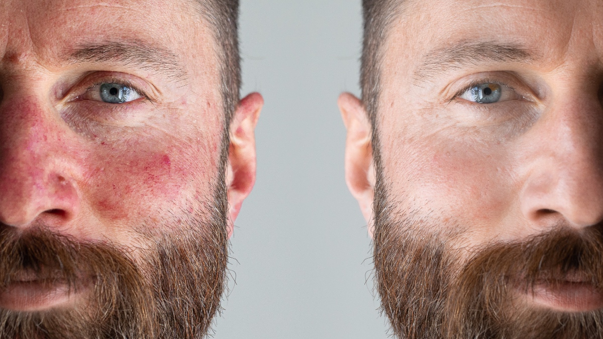 Das Gesicht eines Mannes vor und nach einer Laserbehandlung.