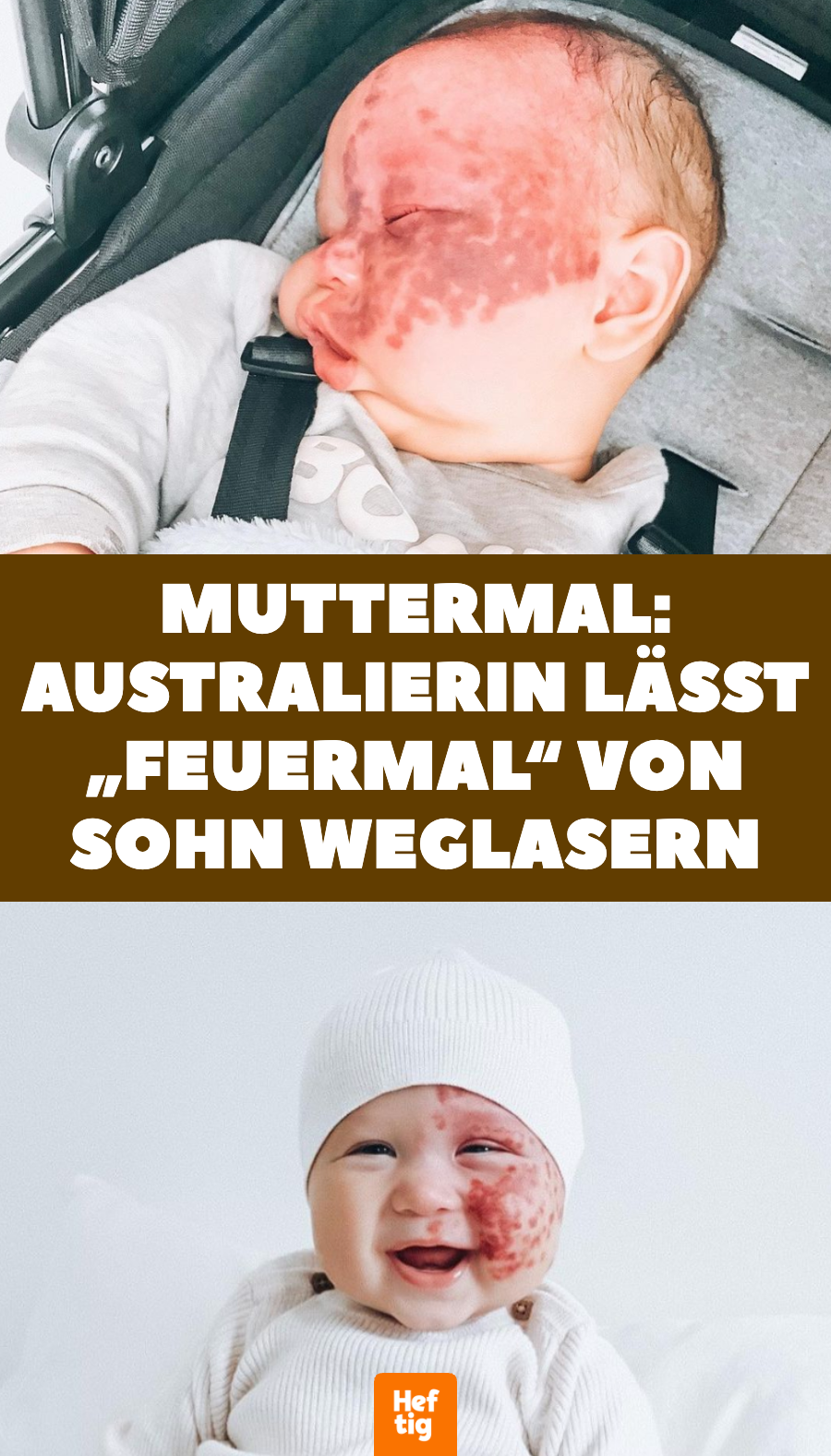 Muttermal: Australierin lässt „Feuermal“ von Sohn weglasern